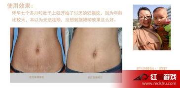 去妊娠纹视频,美丽妈妈蜕变记